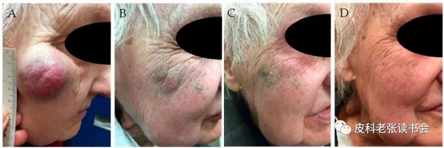 Merkel Cell Carcinoma Is Not Derived From Merkel Cells!