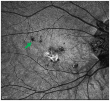 Understanding Multifocal Choroiditis Through Angio-OCT