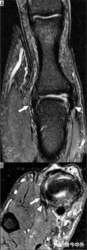 Latest Review: MRI Diagnostic Techniques for Little Finger and Thumb