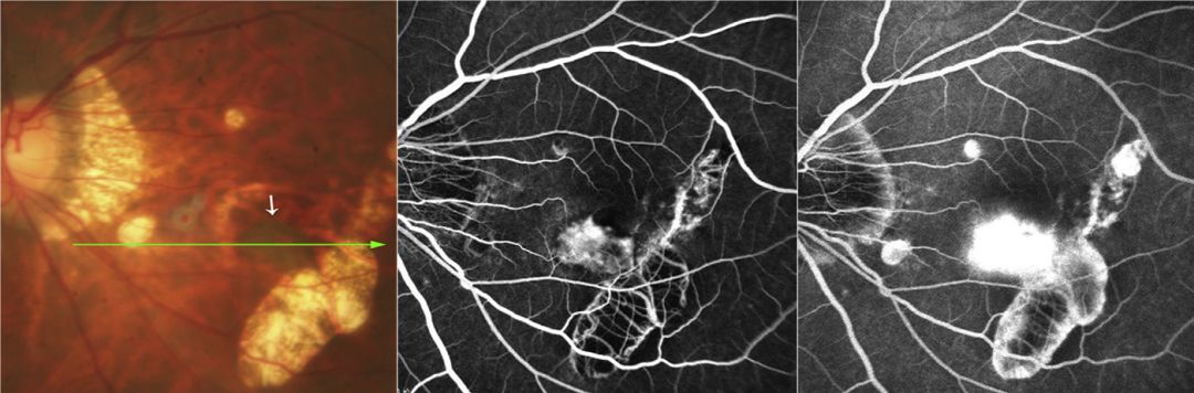 Understanding Multifocal Choroiditis Through Angio-OCT