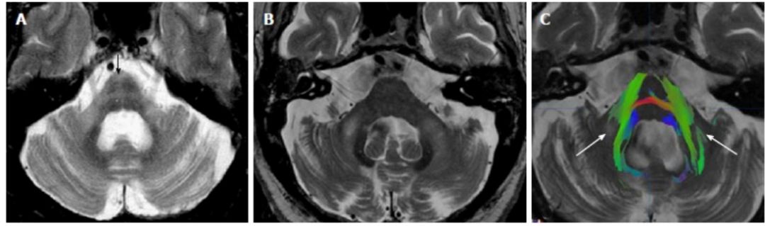 Exploring the Mystery of Middle Cerebellar Peduncles