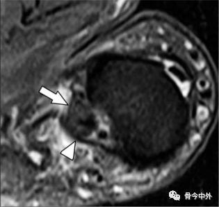 Latest Review: MRI Diagnostic Techniques for Little Finger and Thumb