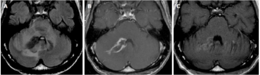 Exploring the Mystery of Middle Cerebellar Peduncles