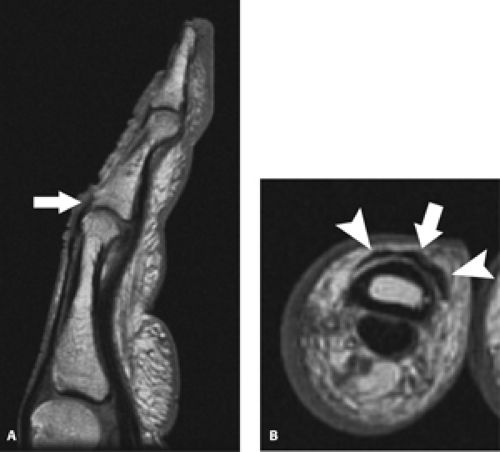 MRI of Finger Tendons