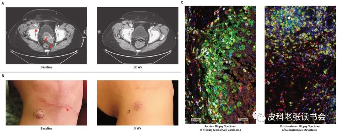 Merkel Cell Carcinoma Is Not Derived From Merkel Cells!