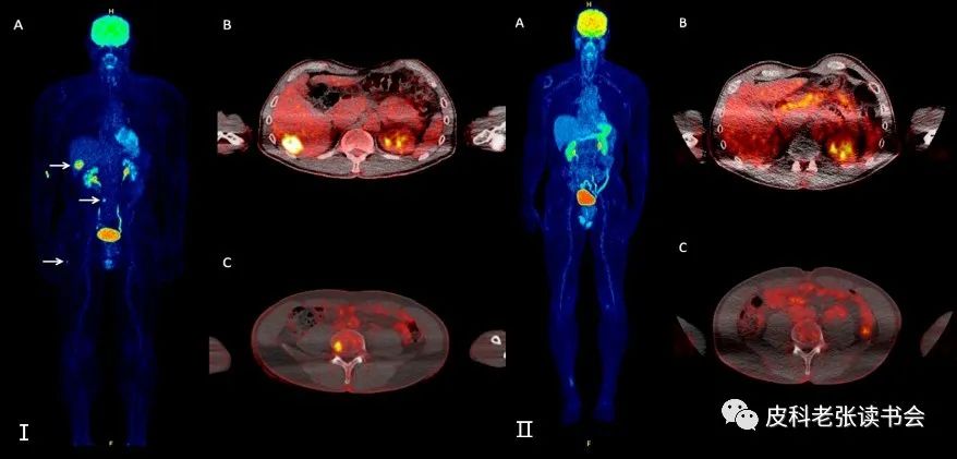 Merkel Cell Carcinoma Is Not Derived From Merkel Cells!
