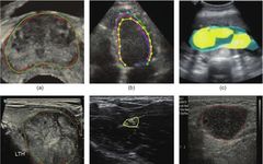 Deep Learning Applications in Medical Ultrasound Image Analysis