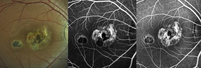 Understanding Multifocal Choroiditis Through Angio-OCT