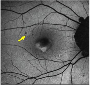 Understanding Multifocal Choroiditis Through Angio-OCT