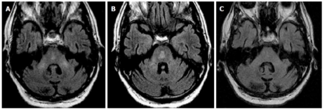Exploring the Mystery of Middle Cerebellar Peduncles