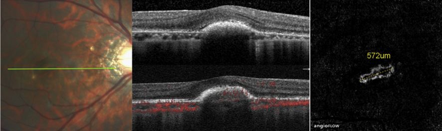 Understanding Multifocal Choroiditis Through Angio-OCT