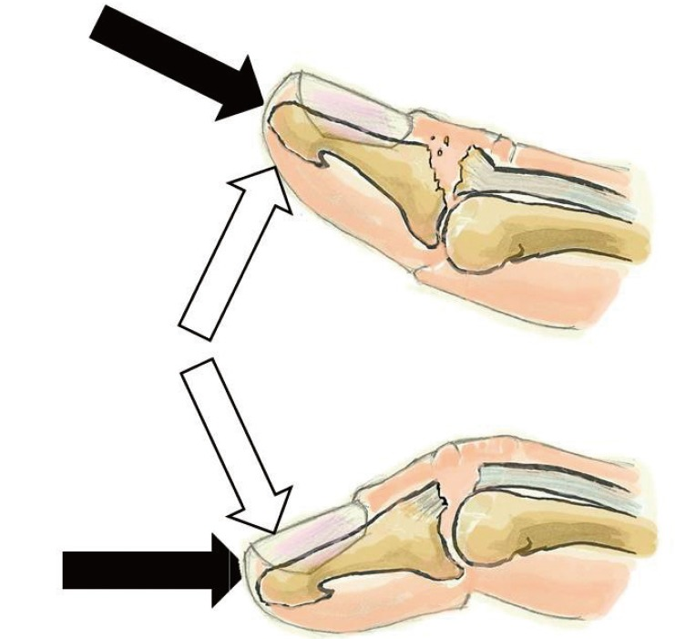 Key Points of Three Types of Hand Joint Injuries