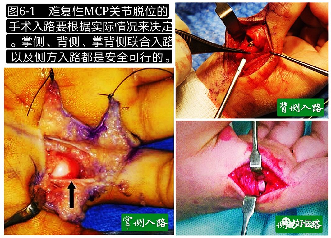 Key Points in the Diagnosis and Treatment of Metacarpophalangeal Joint Dislocation