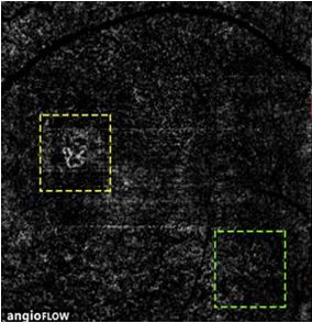 Understanding Multifocal Choroiditis Through Angio-OCT