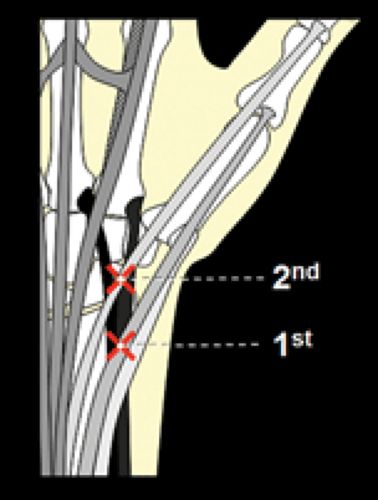 MRI of Finger Tendons