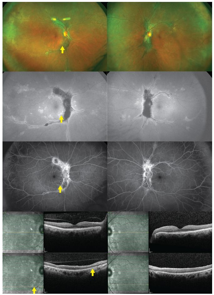 Comprehensive Guide to White Dot Syndromes