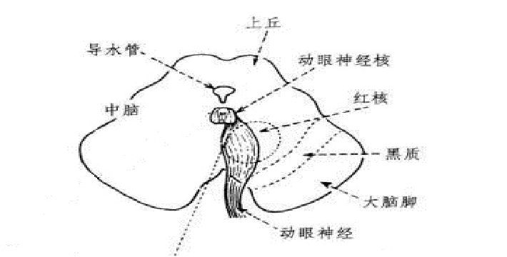 Claude Syndrome: Clinical Report and Analysis