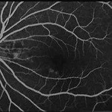 Understanding Multifocal Choroiditis Through Angio-OCT