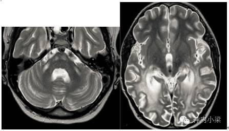 Summary of Lesions in the Middle Cerebellar Peduncle