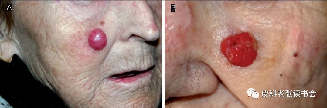 Merkel Cell Carcinoma Is Not Derived From Merkel Cells!