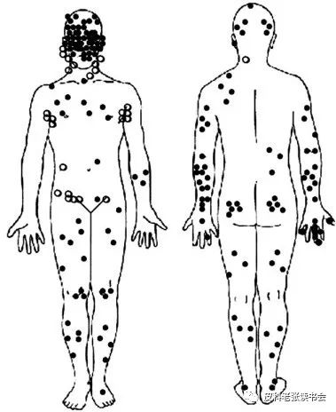 Merkel Cell Carcinoma Is Not Derived From Merkel Cells!