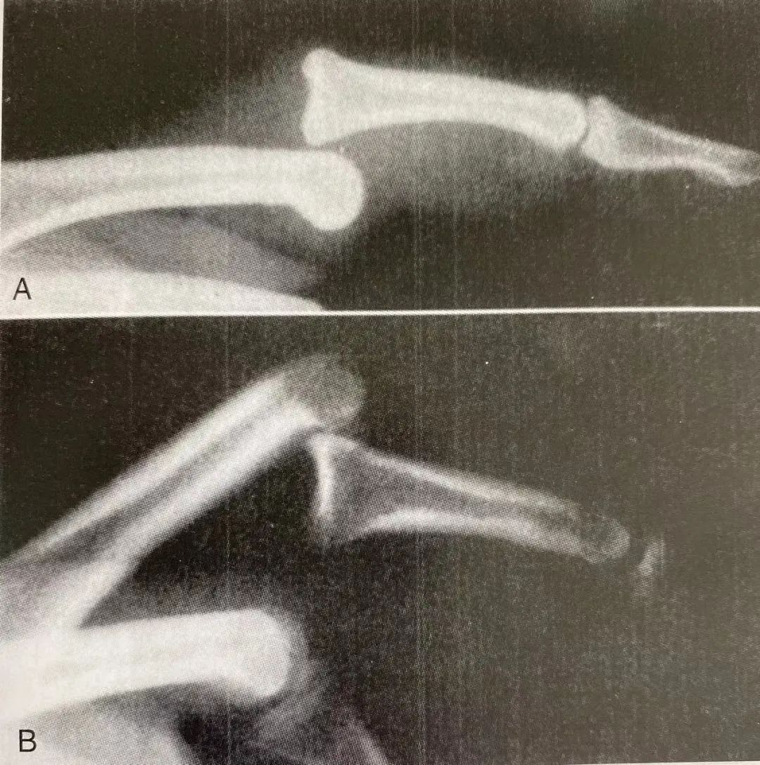 Comprehensive Summary: Treatment Strategies for Four Types of Hand Joint Injuries