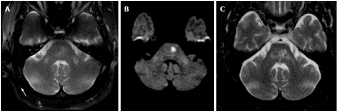 Exploring the Mystery of Middle Cerebellar Peduncles