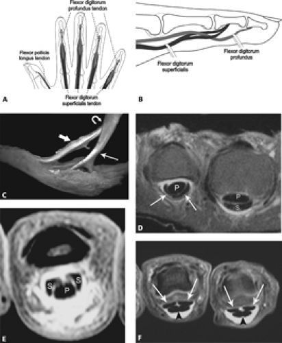 MRI of Finger Tendons
