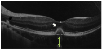 Understanding Multifocal Choroiditis Through Angio-OCT