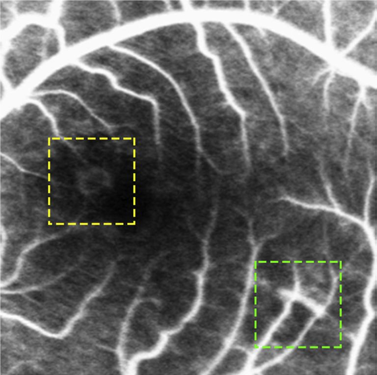 Understanding Multifocal Choroiditis Through Angio-OCT