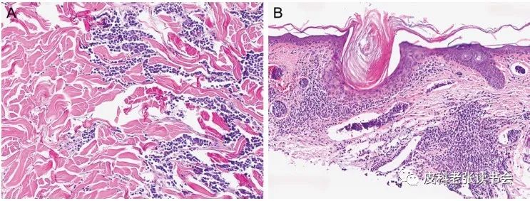Merkel Cell Carcinoma Is Not Derived From Merkel Cells!