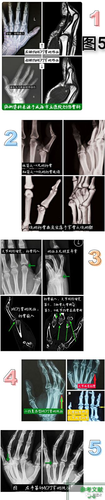Key Points in the Diagnosis and Treatment of Metacarpophalangeal Joint Dislocation