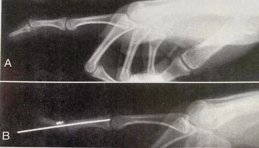 Comprehensive Summary: Treatment Strategies for Four Types of Hand Joint Injuries