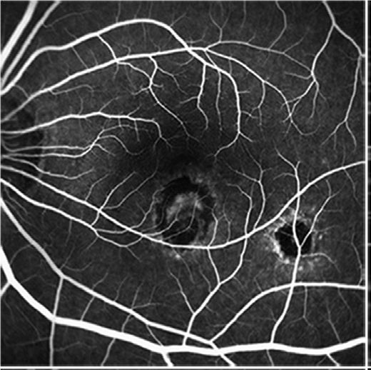 Understanding Multifocal Choroiditis Through Angio-OCT