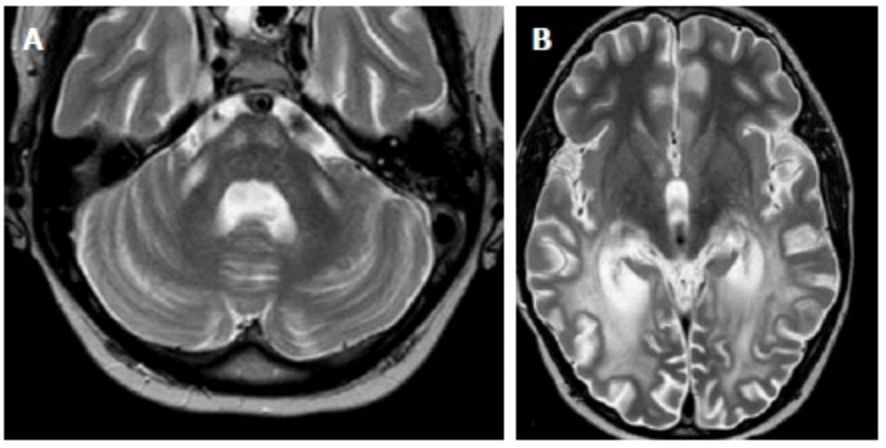 Exploring the Mystery of Middle Cerebellar Peduncles