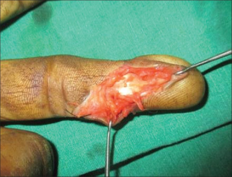 Key Points of Three Types of Hand Joint Injuries