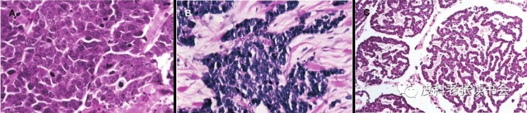 Merkel Cell Carcinoma Is Not Derived From Merkel Cells!