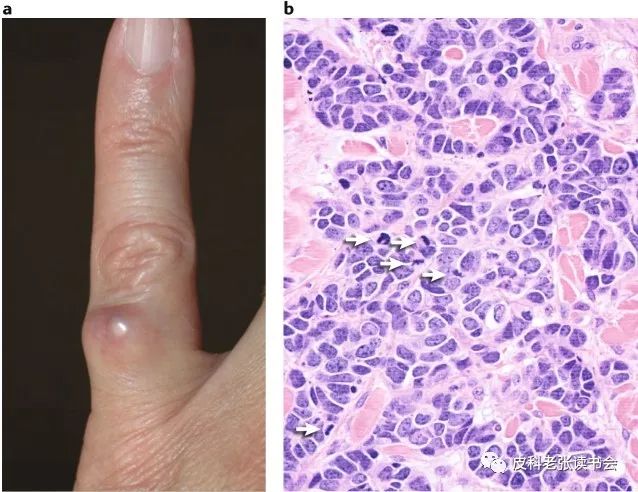 Merkel Cell Carcinoma Is Not Derived From Merkel Cells!