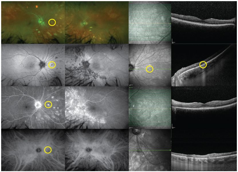 Comprehensive Guide to White Dot Syndromes