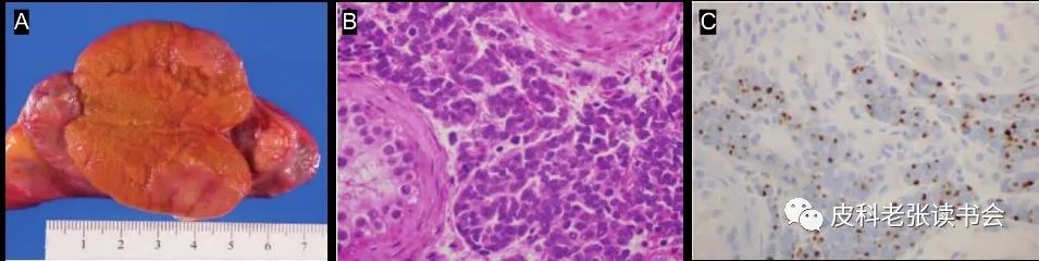 Merkel Cell Carcinoma Is Not Derived From Merkel Cells!