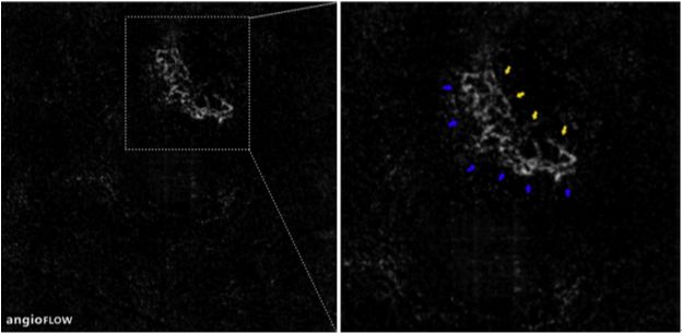 Understanding Multifocal Choroiditis Through Angio-OCT