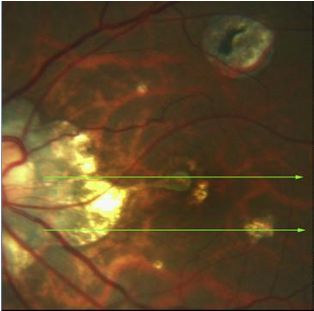 Understanding Multifocal Choroiditis Through Angio-OCT