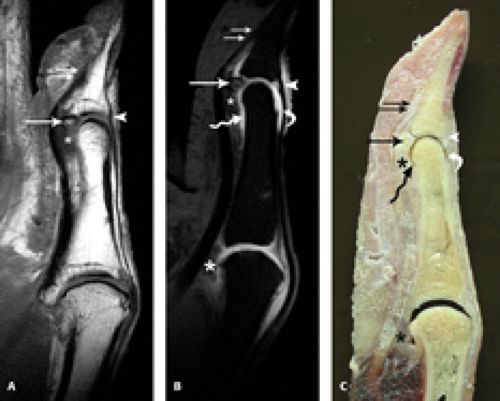 MRI of Finger Tendons