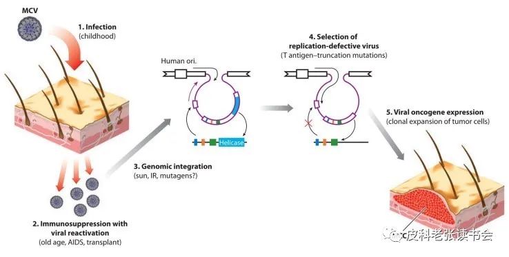 Merkel Cell Carcinoma Is Not Derived From Merkel Cells!