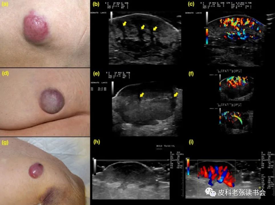 Merkel Cell Carcinoma Is Not Derived From Merkel Cells!
