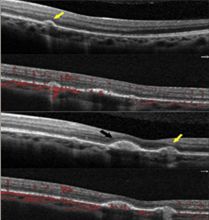 Understanding Multifocal Choroiditis Through Angio-OCT