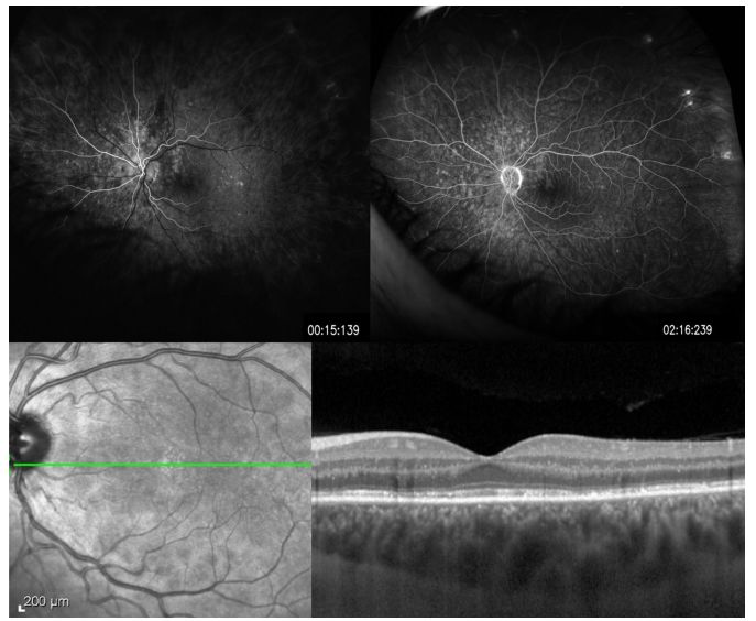 Comprehensive Guide to White Dot Syndromes