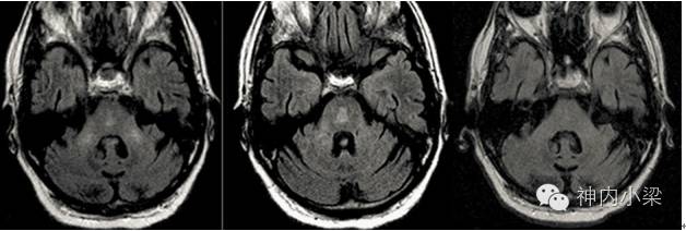 Summary of Lesions in the Middle Cerebellar Peduncle