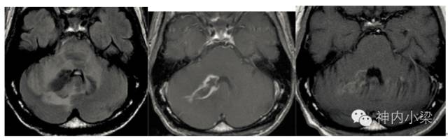 Summary of Lesions in the Middle Cerebellar Peduncle