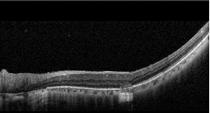 Understanding Multifocal Choroiditis Through Angio-OCT